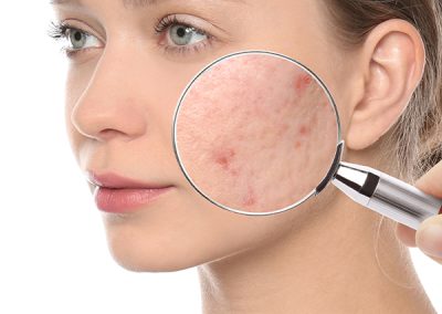 Acne Rosácea e poros dilatados