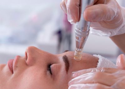 Microagulhamento Facial com Drug Delivery