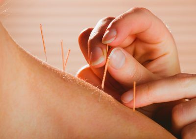 Dry Needling