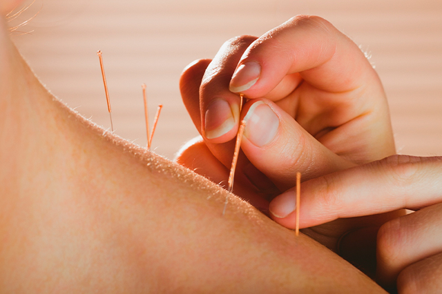 Dry-Needling